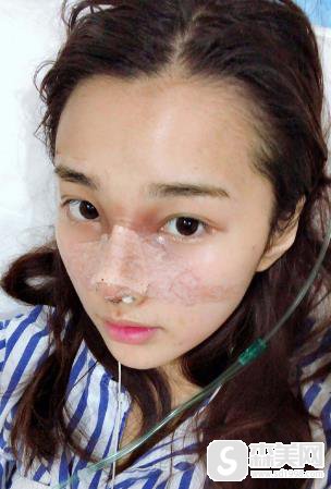 南宁隆鼻梦想医院果怎么样?附隆鼻前后对比
