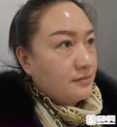 南宁梦想整形医院祛眼袋的果好吗？附恢复详情对比