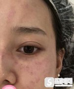 年轻的母亲找到易小玲的医生抱怨，切断了烦人的妊娠斑！