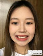 口腔专家欧阳奇明的矫正手术，附矫正恢复图