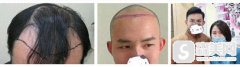 罗平县医院植发好不好?植发加密的果怎么样?案例分享
