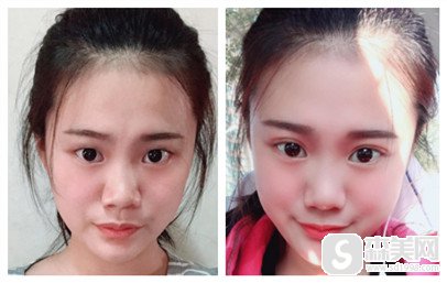 丘金俊医生的技术好不好?做的双眼皮果怎么样?