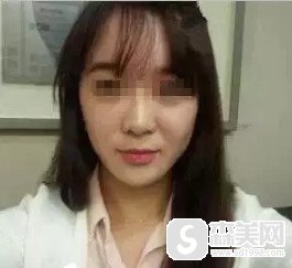 瑞兰玻尿酸除皱的果好不好?真是案例分享