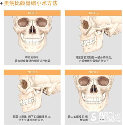 上海张柱允医生的技术怎么样?做的颧骨降低手术怎么样?