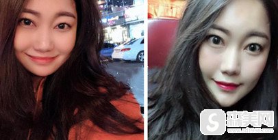 上海张柱允医生的技术怎么样?做的颧骨降低手术怎么样?