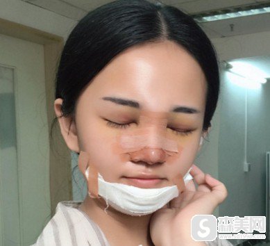 广东美恩整形美容医院好不好?广东美恩整形美容医院整容手术案例