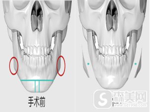 找中家医整形医院的聂云飞做的V-line小脸术,让大圆脸秒变口罩脸