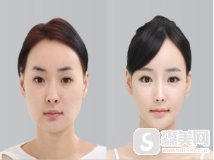 找中家医整形医院的聂云飞做的V-line小脸术,让大圆脸秒变口罩脸