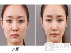 徐威强医生怎么样?技术怎么样?徐威强医生案例