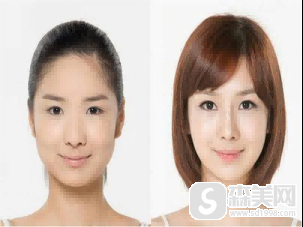 【下巴+下颌角+颧骨颧弓】找徐威强做颌面花了10w,但我觉得真赚
