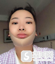 何照华医生的下颌角3D再造术,让我瓜子脸的梦想变真