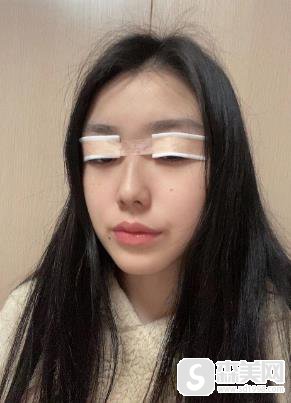 清远华康医院可以做双眼皮吗?果图浏览