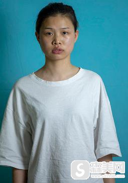 去脸颊脂垫恢复后，成功告别婴儿肥，重庆西南整形科前后对比照片