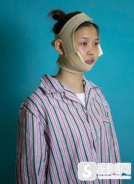 去脸颊脂垫恢复后，成功告别婴儿肥，重庆西南整形科前后对比照片