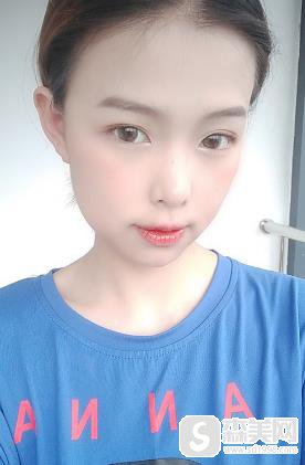 去脸颊脂垫恢复后，成功告别婴儿肥，重庆西南整形科前后对比照片