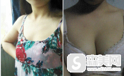 金尚训医生的美胸案例,让我再变傲胸女王!