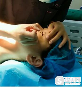 整形医生赵宇的双眼皮手术果?手术前后对比图