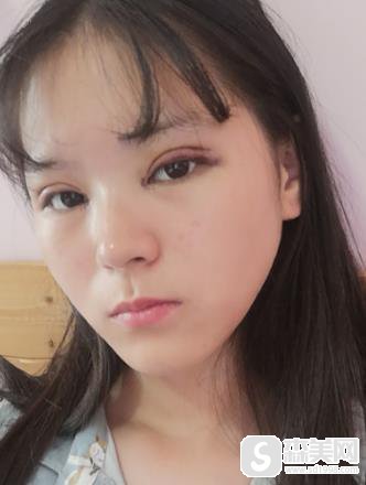 整形医生赵宇的双眼皮手术果?手术前后对比图