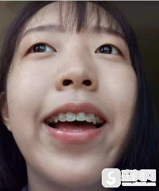 正颌博士刘玥在矫正牙齿中的技术如何？矫正恢复图浏览