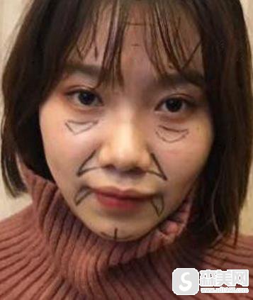 郑州大学第一附属医院面部脂肪填充详情,整形科填充对比图一览