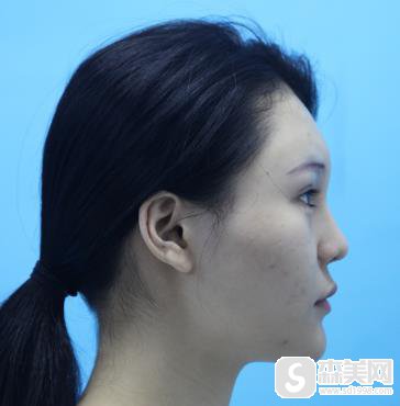 关于中澳整形的面部脂肪案例分析,附恢复对比照片