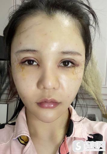 关于中澳整形的面部脂肪案例分析,附恢复对比照片