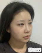 中国医科大学附属盛京医院全切双眼皮案例，附全切恢复过程