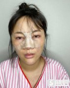 重庆隆鼻皆选星宸，附90天隆鼻果图浏览