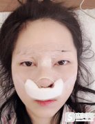 朱敏假体隆鼻手术详情？附隆鼻前后对比照片