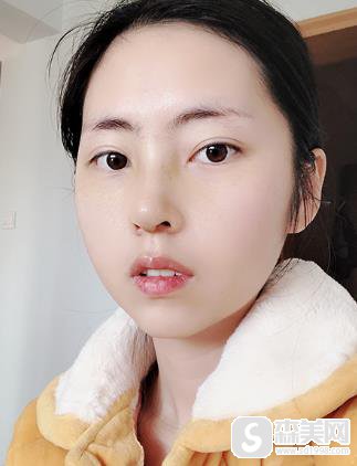朱敏假体隆鼻手术详情？附隆鼻前后对比照片