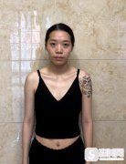 卓彦整形实现的丰胸套餐后，立即拥有挺翘的美胸