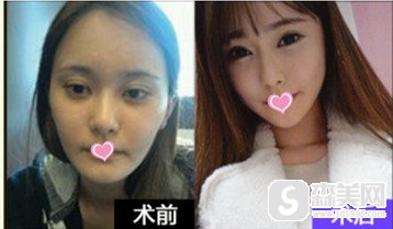 北京基础美整形医院的能力怎么样?进行的颧骨颧弓降低手术果如何?