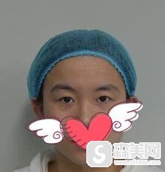 广州佳和医院做的眼部整形手术好不好?案例分享