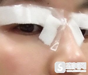 广州佳和医院做的眼部整形手术好不好?案例分享