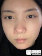 南宁华美胡凯做鼻子技术咋样？附前后对比图浏览
