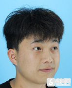 珠海九龙医院靠谱吗？整形科隆鼻90天恢复图