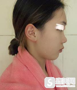 东莞非凡医院双眼皮技术好吗?附整形科恢复图