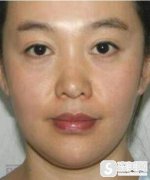 北京注射玻尿酸哪个医生好?郑宗梅填充果图前后对比