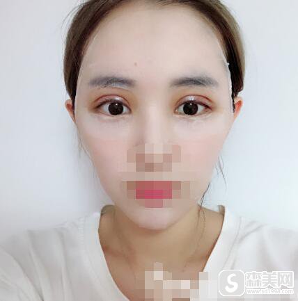 张予曦整容网红前和现在一样吗？双眼皮整容案例