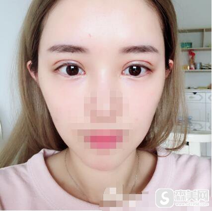 张予曦整容网红前和现在一样吗？双眼皮整容案例