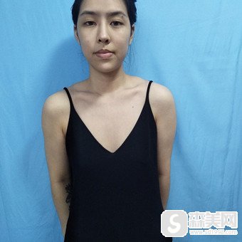 俞冰医生隆胸技术怎么样?做的好吗?隆胸真实案例