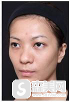 有哪些明星打了爱贝芙?靠谱吗?好用吗?爱贝芙整形案例