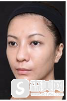 有哪些明星打了爱贝芙?靠谱吗?好用吗?爱贝芙整形案例