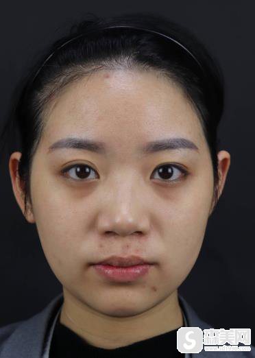 较好玻尿酸品牌排行榜?成都美莱隆鼻恢复图