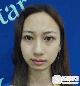 陈誉华院长打玻尿酸打得好的吗?附下巴填充详情对比