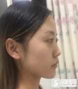 龙华有哪些打玻尿酸的医院?人民医院隆鼻详情对比