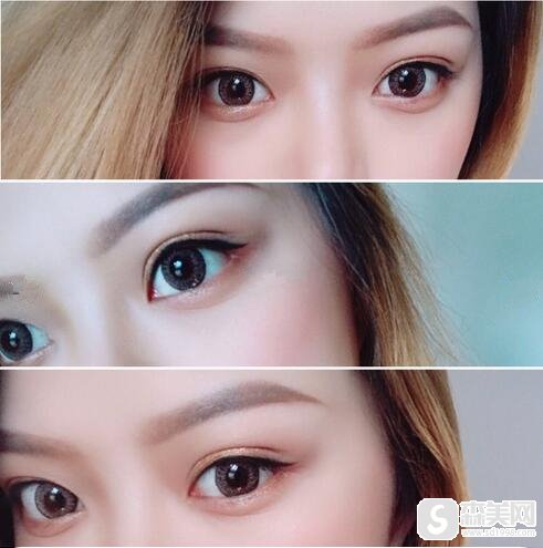 孙俪承认双眼皮是割的，割双眼皮真的好看吗？案例分享