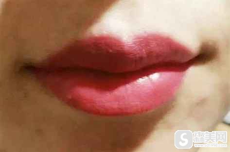 男生纹唇前后对比照片,纹唇需要注意点什么?