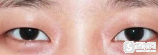 纳米微创双眼皮是长期的吗？怎么做？果展示