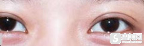 纳米微创双眼皮是长期的吗？怎么做？果展示